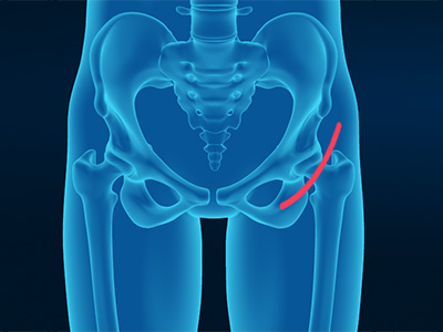 Anterior Hip Replacement - Educational Picture
