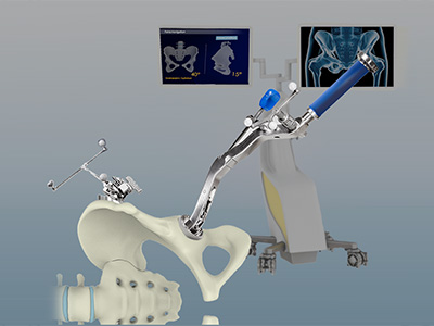 Computer-assisted Hip Replacement - Educational Picture