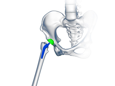 Custom/Patient-Specific Hip Replacement - Educational Picture