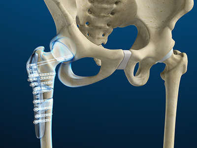 Hip Fracture Surgery - Educational Picture