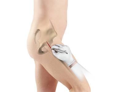 Minimally Invasive Total Hip Replacement - Educational Picture