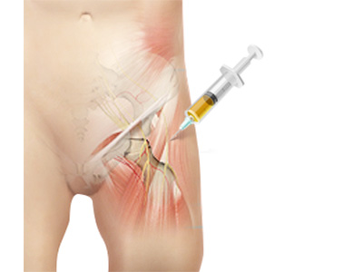 Platelet Rich Plasma (PRP) Injections for the Hip - Educational Picture