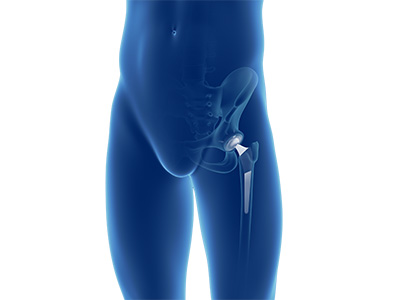 Primary Hip Replacement - Educational Picture