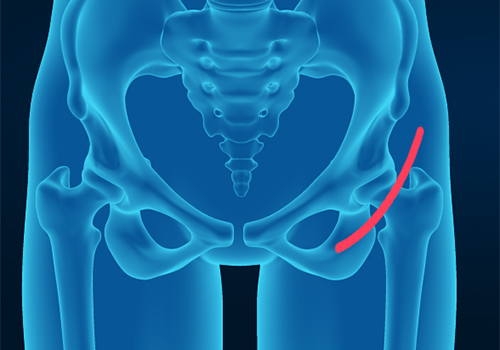 Anterior Hip Replacement - Educational Picture