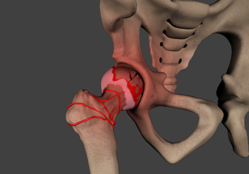 Avascular Necrosis - Educational Picture