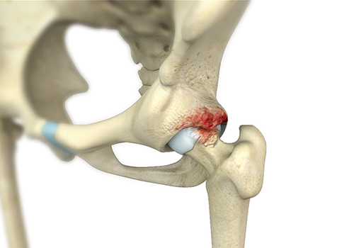 Femoroacetabular Impingement (FAI) - Educational Picture