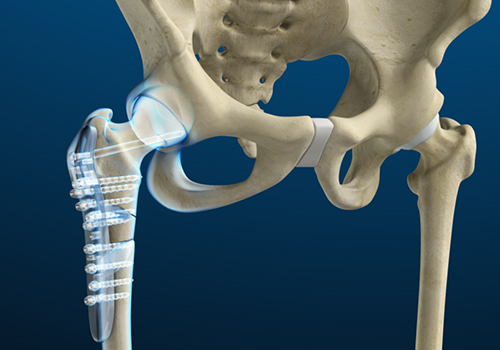 Hip Fracture Surgery - Educational Picture