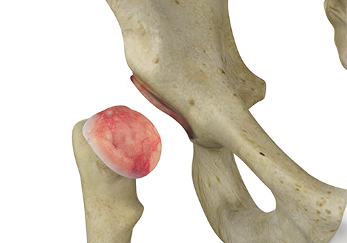 Post-Traumatic Hip Arthritis - Educational Picture
