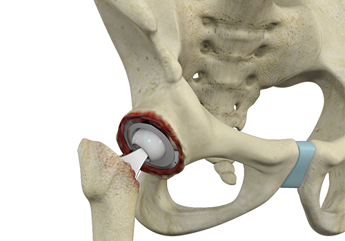 Revision Hip Replacement - Educational Picture